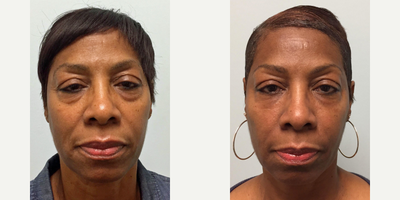 ALMI facial rejuventation - ALMI (Autologous Lipocyte Micronized Injection) was used for facial rejuvenation on this 63 year old patient. With ALMI, her own tissues were used to restore lost volume around her nasolabial folds and to fill in the hollows below her eyes.