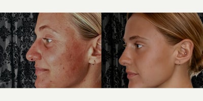 25-34 year old woman treated with Daxxify, HydraFacial - This patient presented with textural irregularities, pigmentation concerns, and early signs of dynamic wrinkles. She sought a treatment plan that would deliver both immediate radiance and long-lasting wrinkle reduction without downtime. Treatment Plan1. Neuromodulator  Daxxify  Focus Areas: Forehead lines, crows feet, glabella (frown lines).  Why Daxxify: Unlike traditional neuromodulators, Daxxify provides longer-lasting results (69 months) by smoothing dynamic wrinkles and preventing deepening of expression lines.  Transformance: Subtle lift of the brows and softening of etched lines creates a fresher, more youthful baseline appearance.2. HydraFacial Series with Customized Boosters  Protocol: 6 HydraFacial treatments spaced every 46 weeks.  Customized Boosters Used:  Britenol & ZO Brightalive: Targeted hyperpigmentation and uneven skin tone.  Dermabuilder Peptide Booster: Improved elasticity and fine lines.  Antioxidant & Hydration Boosters: Reinforced barrier support and deep hydration.  Transformance: The combination of vortex exfoliation, extractions, hydration infusion, and boosters led to dramatic resurfacing with reduction in sun damage, enlarged pores, and textural roughness.Results  Texture: Smoother, more even skin surface with reduced acne scarring and fine lines.  Tone: Noticeable fading of hyperpigmentation and sun damage.  Wrinkles: Dynamic lines softened with Daxxify, creating a more relaxed, refreshed look.  Radiance: Skin appears plump, hydrated, and luminous.Timeline  Immediate: Glow and hydration after each HydraFacial.  4 Weeks: Wrinkle reduction visible from Daxxify onset.  3 Months: Cumulative resurfacing benefits from HydraFacial series.  69 Months: Sustained wrinkle relaxation with Daxxify, long-term improvement in tone and texture maintained through HydraFacial maintenance.Final NoteThis combined protocol demonstrates how strategic pairing of neuromodulation with advanced skin resurfacing can achieve both corrective and preventative outcomesa true transformance rather than a quick fix.