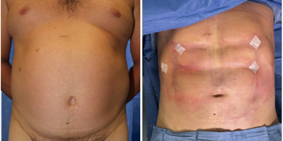 35-44 year old Man treated with Body Lift - This is a 39-year-old male patient who traveled from Arizona. After diet and exercise, he had trouble losing weight in his abdomen. He wanted toned and defined abs, so he could be topless during Arizonas hot summers. He underwent VASER Hi-Def liposuction.This procedure took about 4 hoursForm of anesthesia: General anesthesiaRecovery to return to sitting type job: 1-2 weeksRecovery to return to very active type job: 2-3 weeksReturn to limited activity: 3-4 weeksReturn to full activity: 6-8 weeksCost: depends on your plastic surgeon