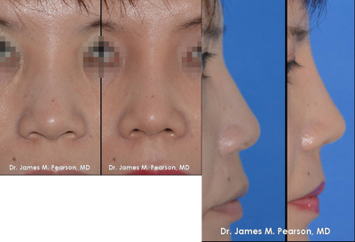 Rhinoplasty / Nasal Surgery - 
	Rhinoplasty / Nasal Surgery by Dr. James M. Pearson, MD

