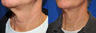 Laser Treatment - Fantastic neck skin firming results already after just 1 SkinTyte&trade; treatment with our Sciton&nbsp;multi-purpose laser.