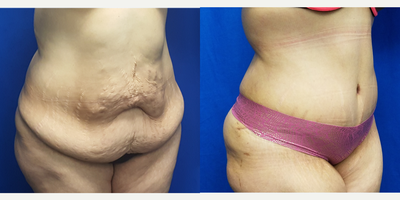 35-44 year old woman treated with Mommy Makeover - 38 year old female who is 3 months after a tummy tuck. This is her first surgery as part of her mommy makeover. She had a gastric sleeve in 2013 and lost 70 lbs. She was concerned about the loose skin and stretch marks. She has 3 children. Her preoperative height was 5 feet and 1 inch and her weight was 167 lbs. Her weight at the time of the photo was 158 lbs. No liposuction was done at this stage.