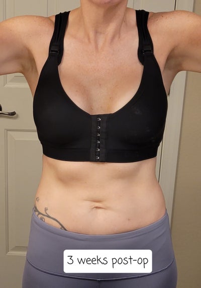 415cc Silicone, 5'8 130lb - Robert M. Jensen, MD - Review - RealSelf