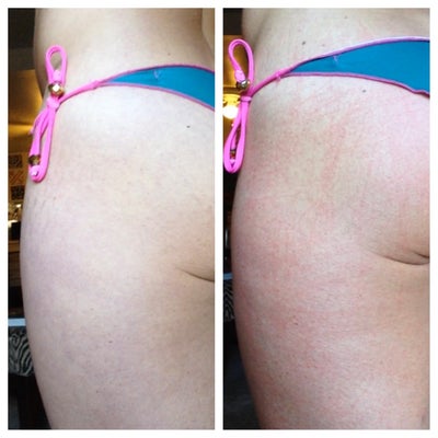 Home Stretch Marks, Rolling for Derma at Cellulite
