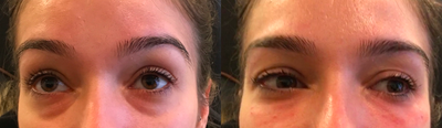25-34 year old woman treated with Restylane Refyne for tear trough correction - Correction of under eye bags with Restylane Refyne.