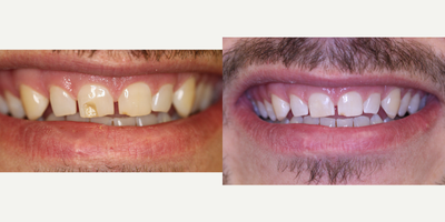 25-34 year old man treated with Dental Bonding - Patient presented with an emergency of a broken front tooth from a trauma earlier in the day. Patient only wanted the broken tooth repaired and did not want to fix the chip on the neighboring tooth that he had forever. Cosmetic bonding was done by Dr. Davidowitz to fully restore the fractured enamel back to a natural looking central incisor.