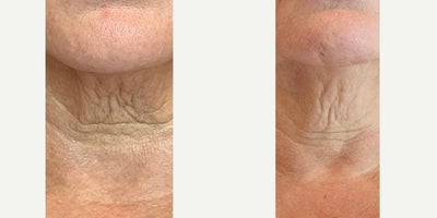 55-64 year old woman treated with Morpheus8 - Morpheus8 Neck treated by Alyssa G