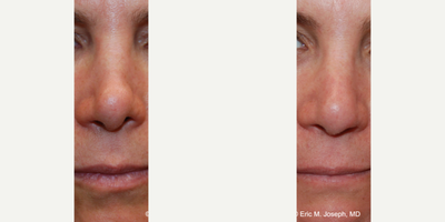 55-64 year old woman treated with Nonsurgical Nose Job, Silicone Injections - You can see a natural looking and unoperated nasal appearance in our patient who received 3 microdroplet silicone 1000 injections over the course of 2 years. Before her treatment, she had several stigmata of previous nasal surgery, Namely tip asymmetry, nostril margin asymmetry, and a pinched appearance. In our experience over 24 years, microdroplet silicone 1000 nasal injections are safe and lead to natural looking nasal appearances especially when there was previous rhinoplasty surgery and additional nasal volume would be of benefit for producing a more natural appearance. Unlike temporary gel fillers like HA, Silikon-1000 is never associated with necrosis, blindness, stroke, infection or biofilm formation. Additionally, permanent non-surgical nose job procedures with Silikon-1000 have been safe and effective for over 60 years.