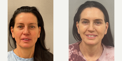 56 year old woman treated with NaturalLift, Upper Eyelid Blepharoplasty, Fat Transfer Cheeks, Laser Lower Eyelids - 56 year old woman treated with NaturalLift, Upper Eyelid Blepharoplasty, Fat Transfer Cheeks, Laser Lower Eyelids
