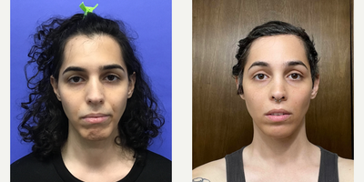 25-34 year old transgender woman treated with Rhinoplasty, Septoplasty - 25 to 34 year-old female patient is 1 year post-op from Facial Feminization surgery. Her procedures included: Forehead Lift, Hairline Lowering, Orbital Bony Contouring, Septorhinoplasty (closed) with Cartilage Grafts, Chin Implant (central) with Contour and Reduction, 1cc Voluma, Thyroid Cartilage Shave, Soft Tissue to Nasolabial Folds, and 300 Micrografts to Recessions.