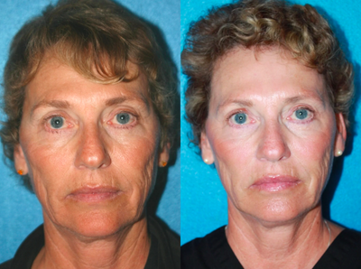 Sculptra Aesthetic Injections - 	Sculptra Aesthetic Injections