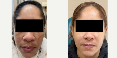 45-54 year old woman treated with Pico Genesis - Before and after pico genesis