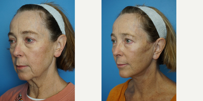 65-74 year old woman treated with Deep Plane Facelift - Deep Plane High SMAS with fat transfer