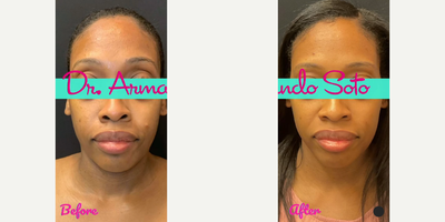 Woman treated with Laser Peel - Woman treated with Laser Peel