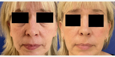 Woman treated with Sofwave - Photo provided courtesy of Sofwave, performed by Anna Buinewicz, MD
