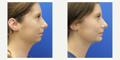 25-34 year old woman treated with Chin Implant, Chin Liposuction - When you combine chin augmentation and liposuction the entire face is balanced for an overall aesthetic effect. Recovery is tolerable and she is certainly thrilled about her results seen at only 6 weeks.