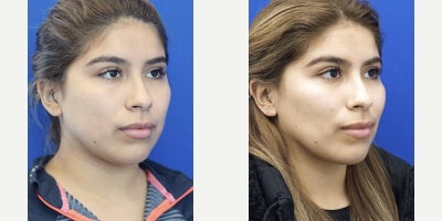 25-34 year old woman treated with Buccal Fat Removal - Buccal fat resection done under local anesthesia remains one of the most effective and permanent procedures to allow cheek contouring. The illusion of higher cheek bone and defined jawline achieves high satisfaction.