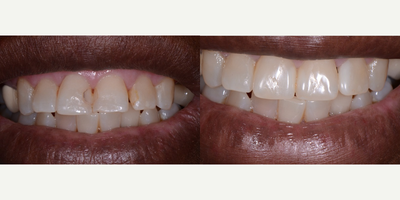 55-64 year old woman treated with Tooth Repair - These teeth were discolored from old and leaking fillings--we also closed the space with her restorations