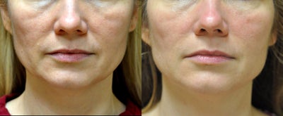 43 Year Old Woman treated with Ultherapy and Sculptra - 
	4 months post-treatments. Treated with Ultherapy and 1 vial of Sculptra.
