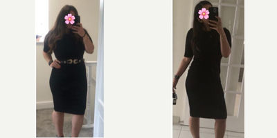 25-34 year old woman treated with Gastric Balloon - This beautiful patient came to us to lose weight, and was very happy with the result thanks to our gastric balloon treatment