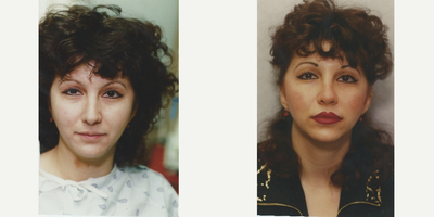 Lip enhancement - three injections of silikon 1000 to the lips, 4 weeks apart.