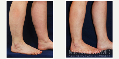 45-54 year old woman treated with Calf Reduction - Lower leg liposcution