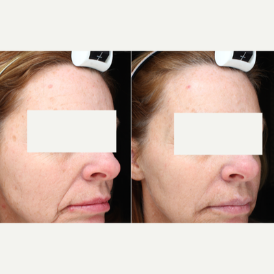 Laser Resurfacing before and after photo