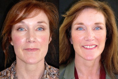 Facelift before and after photo