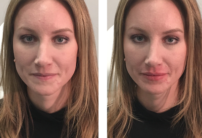 Restylane before and after photo