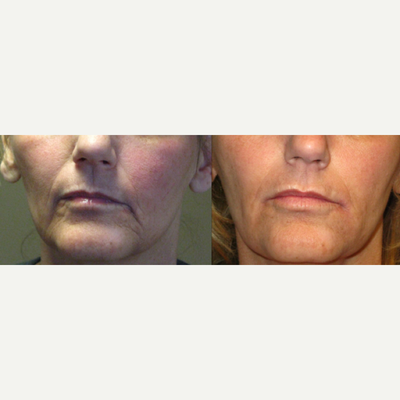 Bellafill before and after photo