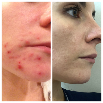 Halo Laser before and after photo