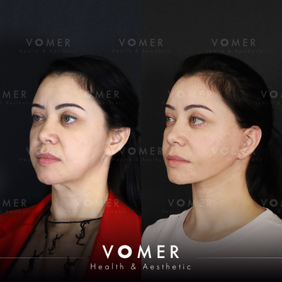 Lower Facelift before and after photo