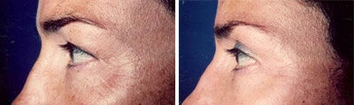 Eyelid Surgery before and after photo
