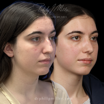 Rhinoplasty before and after photo