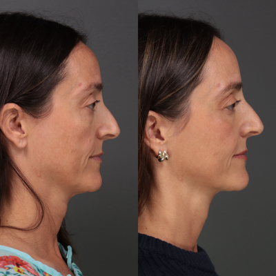 Eyelid Surgery before and after photo