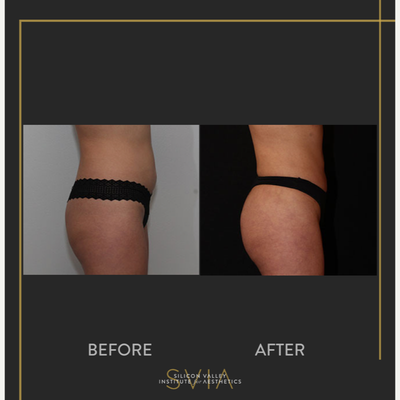 Brazilian Butt Lift before and after photo
