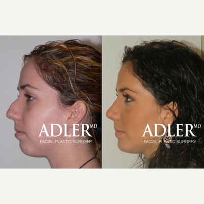 Rhinoplasty before and after photo