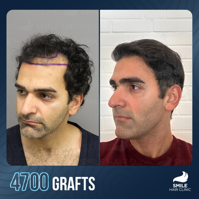 FUE Hair Transplant before and after photo
