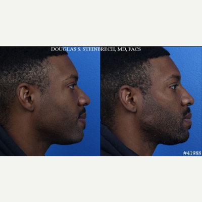 Voluma before and after photo