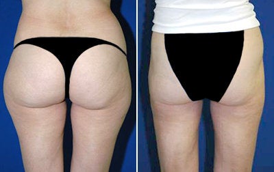 Liposuction before and after photo