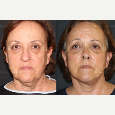 Mini Facelift before and after photo