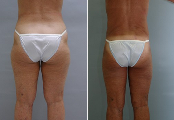 Tummy Tuck before and after photo