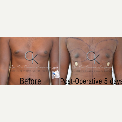 Gynecomastia Surgery before and after photo