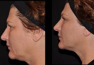 Ultherapy before and after photo