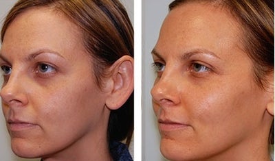 Juvederm before and after photo