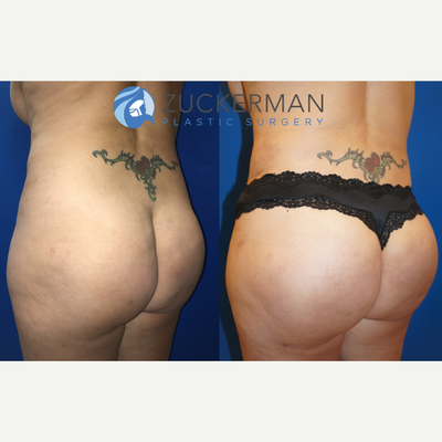 Brazilian Butt Lift before and after photo