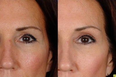 Botox before and after photo