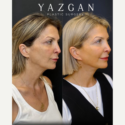 Neck Lift before and after photo