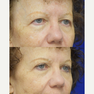 Brow Lift before and after photo