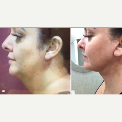 Neck Lift before and after photo
